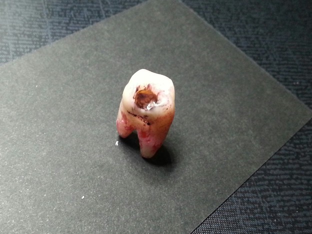 上顎第２大臼歯カリエス(虫歯)アクセサリー